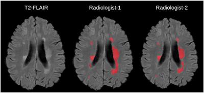 Clinically Deployed Computational Assessment of Multiple Sclerosis Lesions